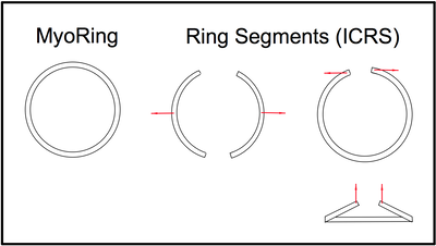 Ringsegmente